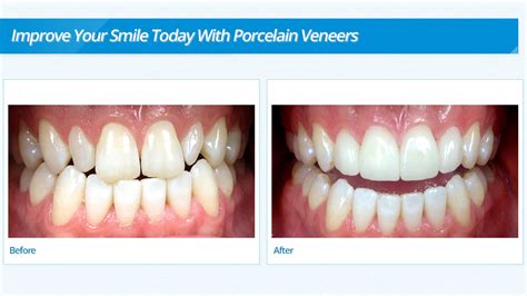 porcelain veneers burnsville mn